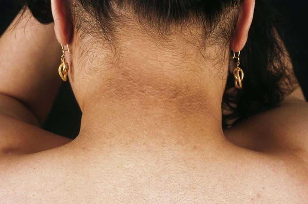 Mujer con resistencia a la insulina